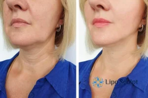 Double chin before and after Hi-Fu treatment 4 Book your double chin treatment Walton today! We are here to help!