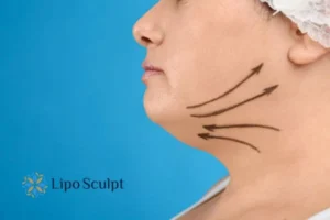Double chin before and after Hi-Fu treatment 3 Boost your confidence with a Double chin treatment Walton