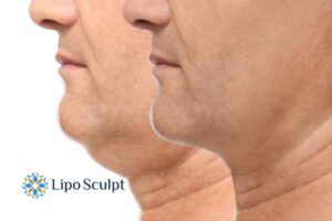 Double chin before and after Hi-Fu treatment 2 Double chin treatment Walton from Lipo Sculpt - feel more confident today!