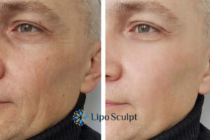 How to Fight Aging Symptoms 3 Fight Aging Symptoms Walton With HIFU and Morpheus8 Today!
