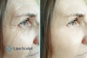 How to Fight Aging Symptoms 2 Do you want to Fight Aging Symptoms Walton? Contact Lipo Sculpt today!