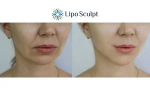 Explaining Total Skin Tightening Treatment And What It Can Do For You 2 Do you want to boost your self confidence? Give Morpheus8 Walton a try today!