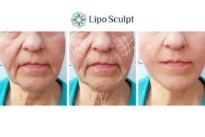 Explaining Total Skin Tightening Treatment And What It Can Do For You 3 Boost your confidence with Morpheus8 Walton call our team today!