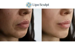 Explaining Total Skin Tightening Treatment And What It Can Do For You 4 Morpheus8 Walton the best results - call our team today!