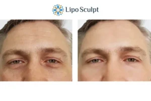 Explaining Total Skin Tightening Treatment And What It Can Do For You 6 Morpheus8 Walton book in today to find out more!