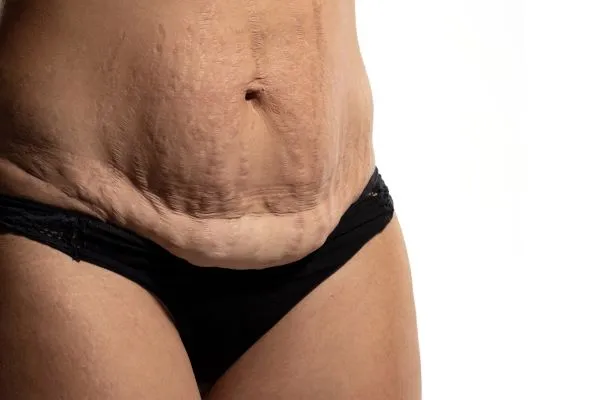 Lost the Weight but Not the Loose Skin? 1 image of womans stomach after weight loss showing loose skin Walton